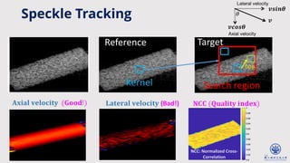 14
Search region
Kernel
Target
Reference
𝐍𝐂𝐂 (𝐐𝐮𝐚𝐥𝐢𝐭𝐲 𝐢𝐧𝐝𝐞𝐱)
𝐀𝐱𝐢𝐚𝐥 𝐯𝐞𝐥𝐨𝐜𝐢𝐭𝐲 (𝐆𝐨𝐨𝐝!)
Disp.
𝐋𝐚𝐭𝐞𝐫𝐚𝐥 𝐯𝐞𝐥𝐨𝐜𝐢𝐭𝐲 (Bad!)
Speckle Tracking
NCC: Normalized Cross-
Correlation
 