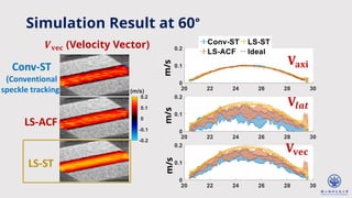 Simulation Result at 60°
LS-ST
Conv-ST
(Conventional
speckle tracking)
-0.2
-0.1
0
0.1
0.2
(m/s)
LS-ACF
m/s
𝐕𝐚𝐱𝐢
𝐕𝒍𝒂𝒕
𝐕𝐯𝐞𝐜
m/s
m/s
𝑽𝐯𝐞𝐜 (Velocity Vector)
 
