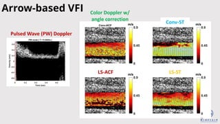 26
Arrow-based VFI Color Doppler w/
angle correction
LS-ACF
Conv-ST
LS-ST
Pulsed Wave (PW) Doppler
 