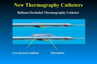 New Thermography Catheters
Balloon-Occluded Thermography Catheter
Low pressure balloon Thermistor
 