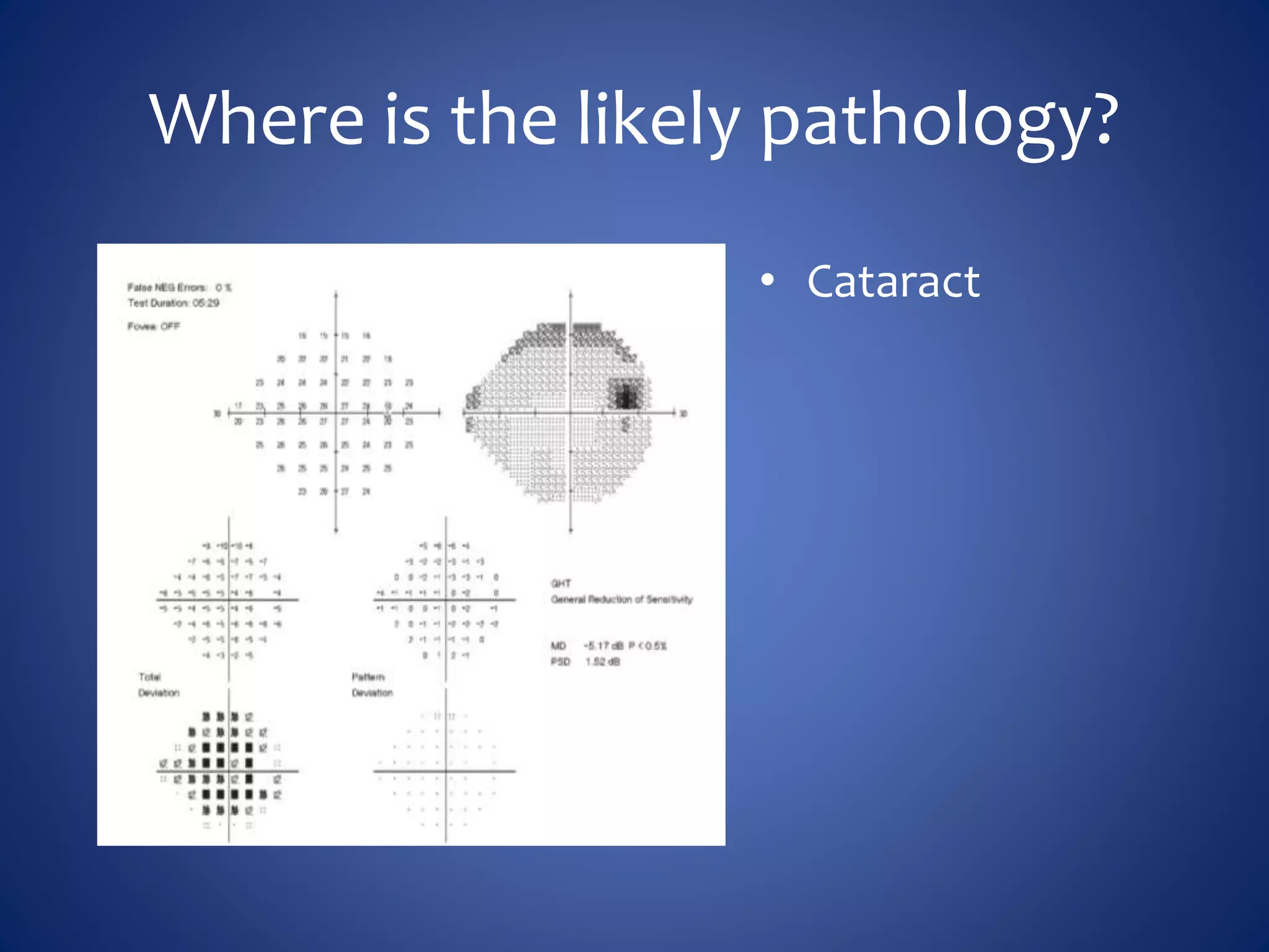 Where is the likely pathology?
• Cataract
 