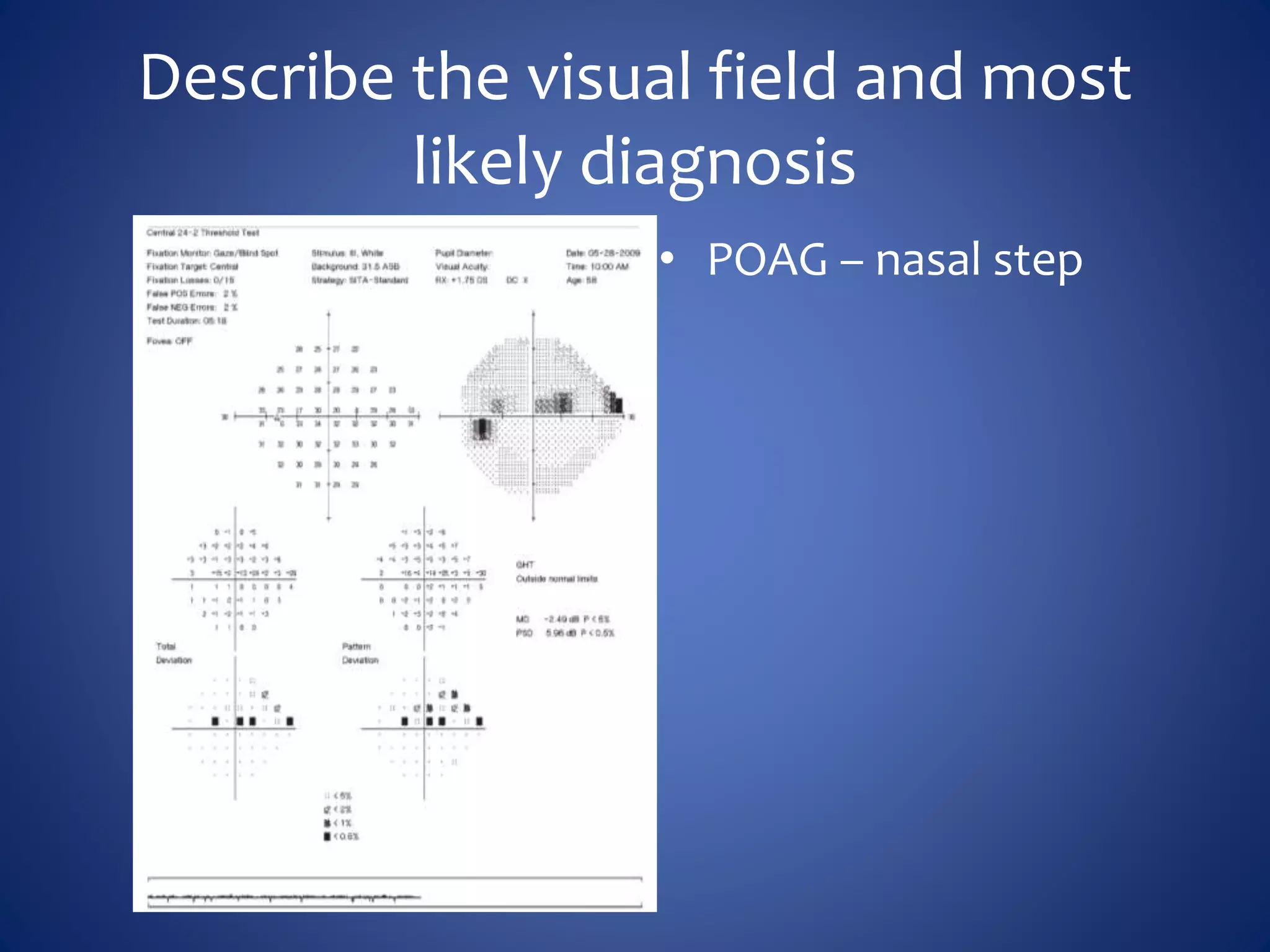 Describe the visual field and most
likely diagnosis
• POAG – nasal step
 