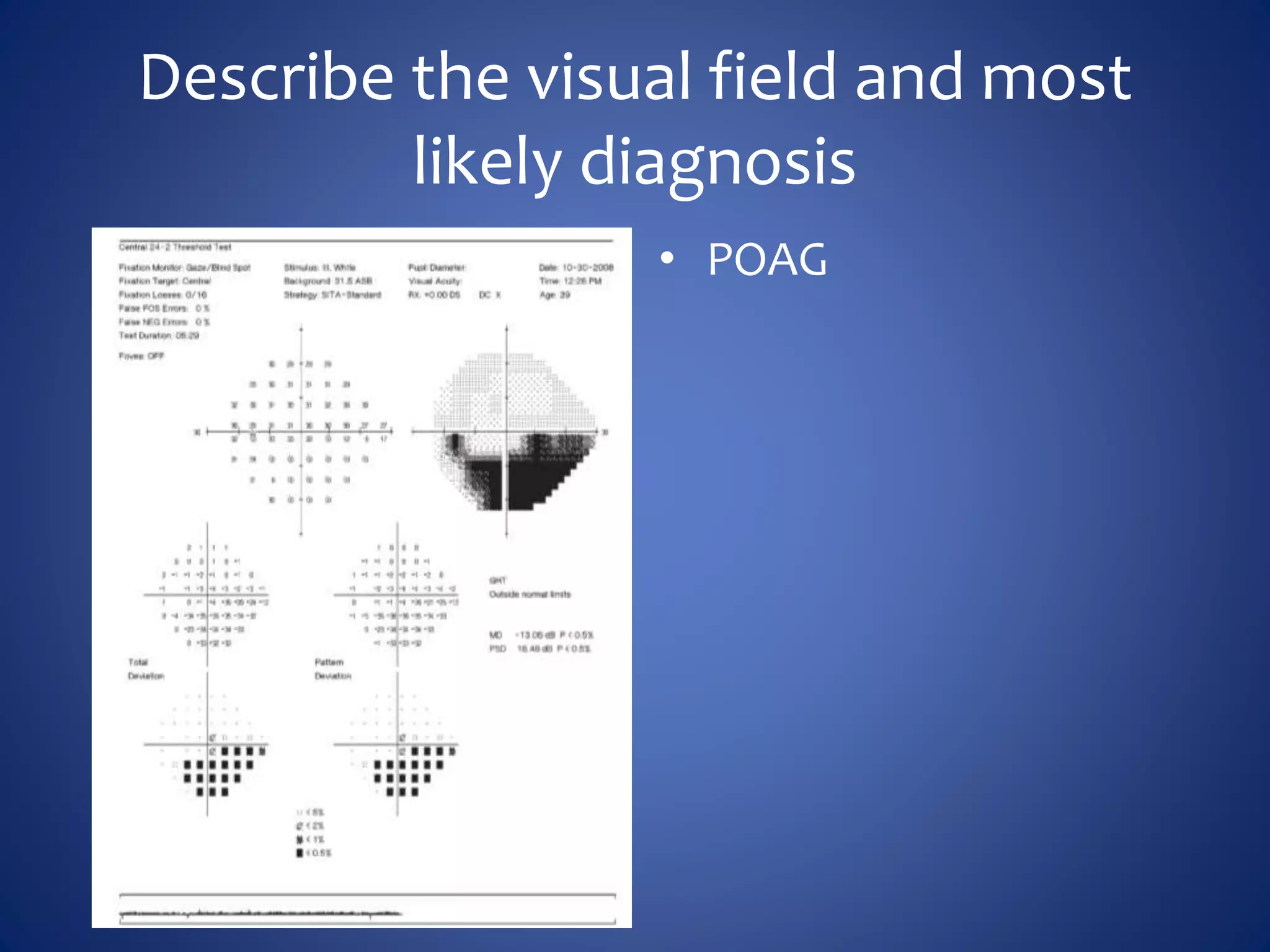 Describe the visual field and most
likely diagnosis
• POAG
 