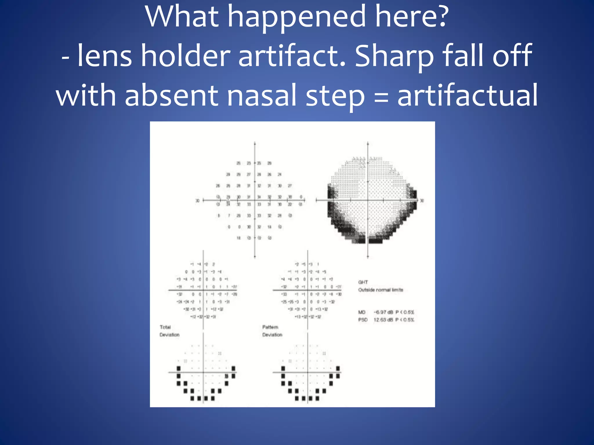 What happened here?
- lens holder artifact. Sharp fall off
with absent nasal step = artifactual
 