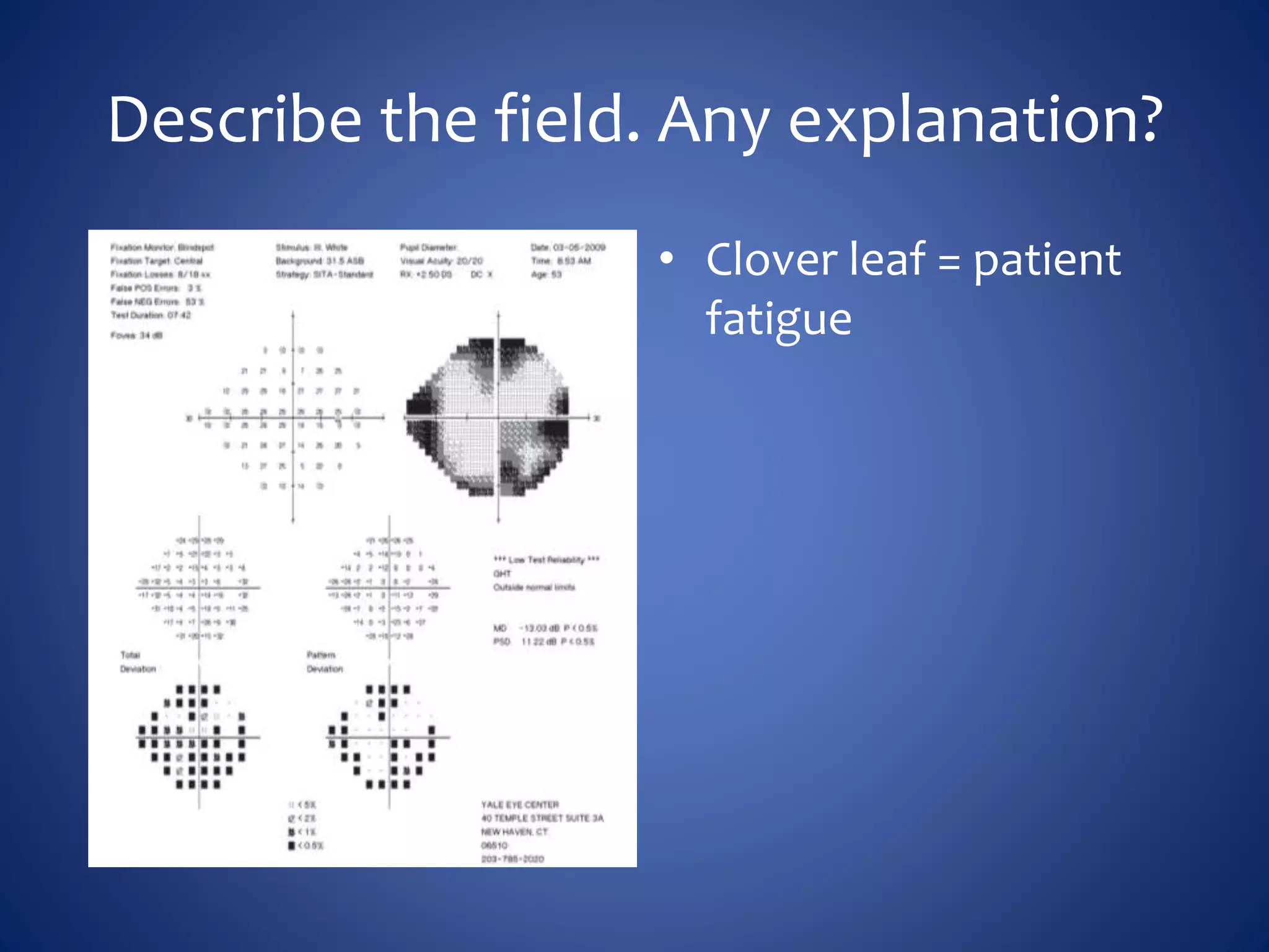Describe the field. Any explanation?
• Clover leaf = patient
fatigue
 