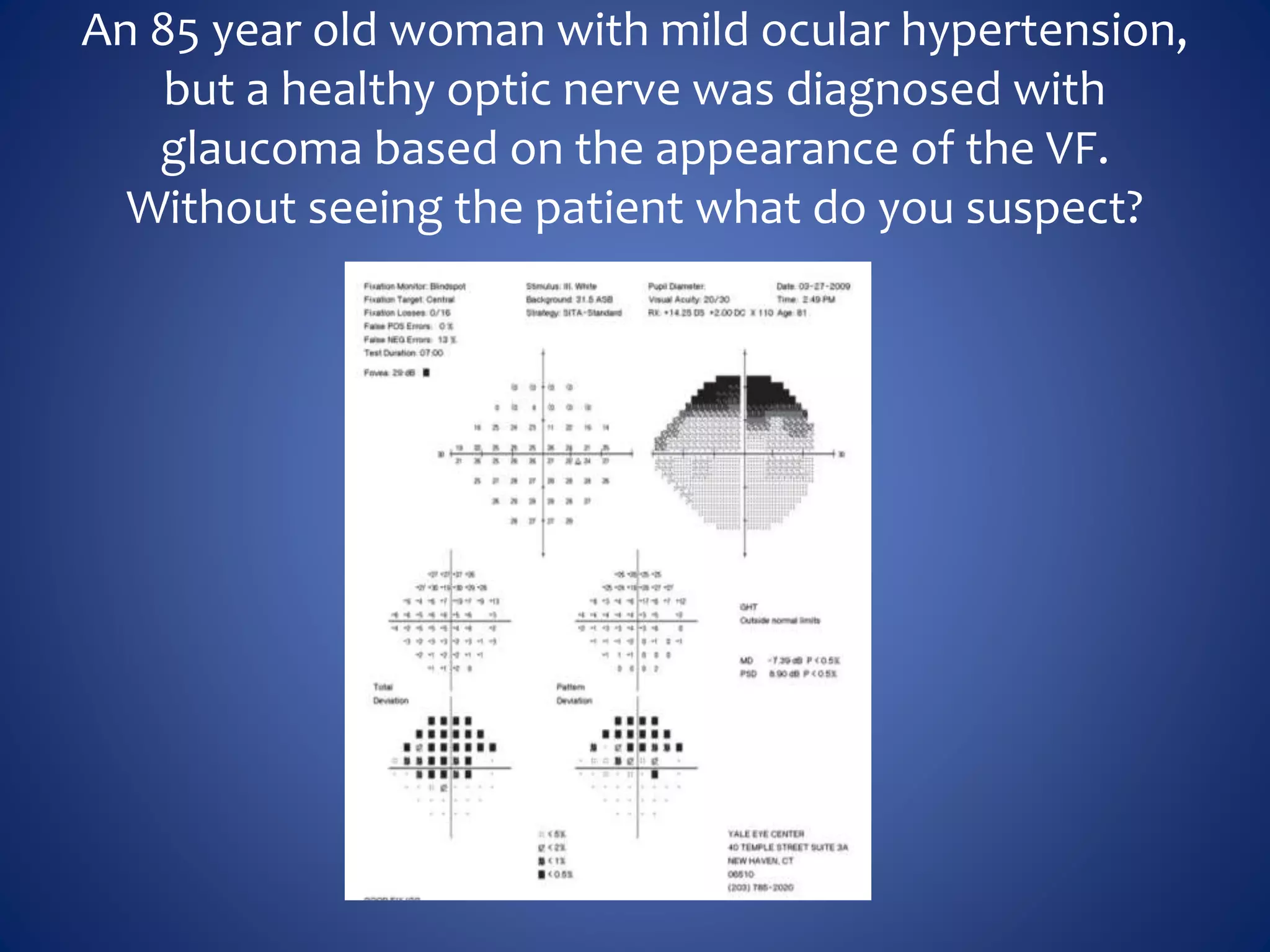 An 85 year old woman with mild ocular hypertension,
but a healthy optic nerve was diagnosed with
glaucoma based on the appearance of the VF.
Without seeing the patient what do you suspect?
 