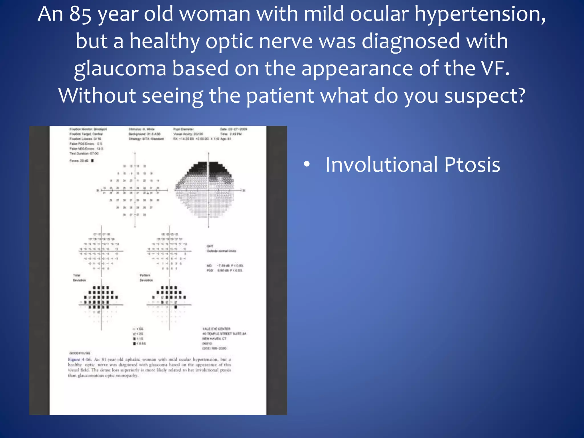 An 85 year old woman with mild ocular hypertension,
but a healthy optic nerve was diagnosed with
glaucoma based on the appearance of the VF.
Without seeing the patient what do you suspect?
• Involutional Ptosis
 