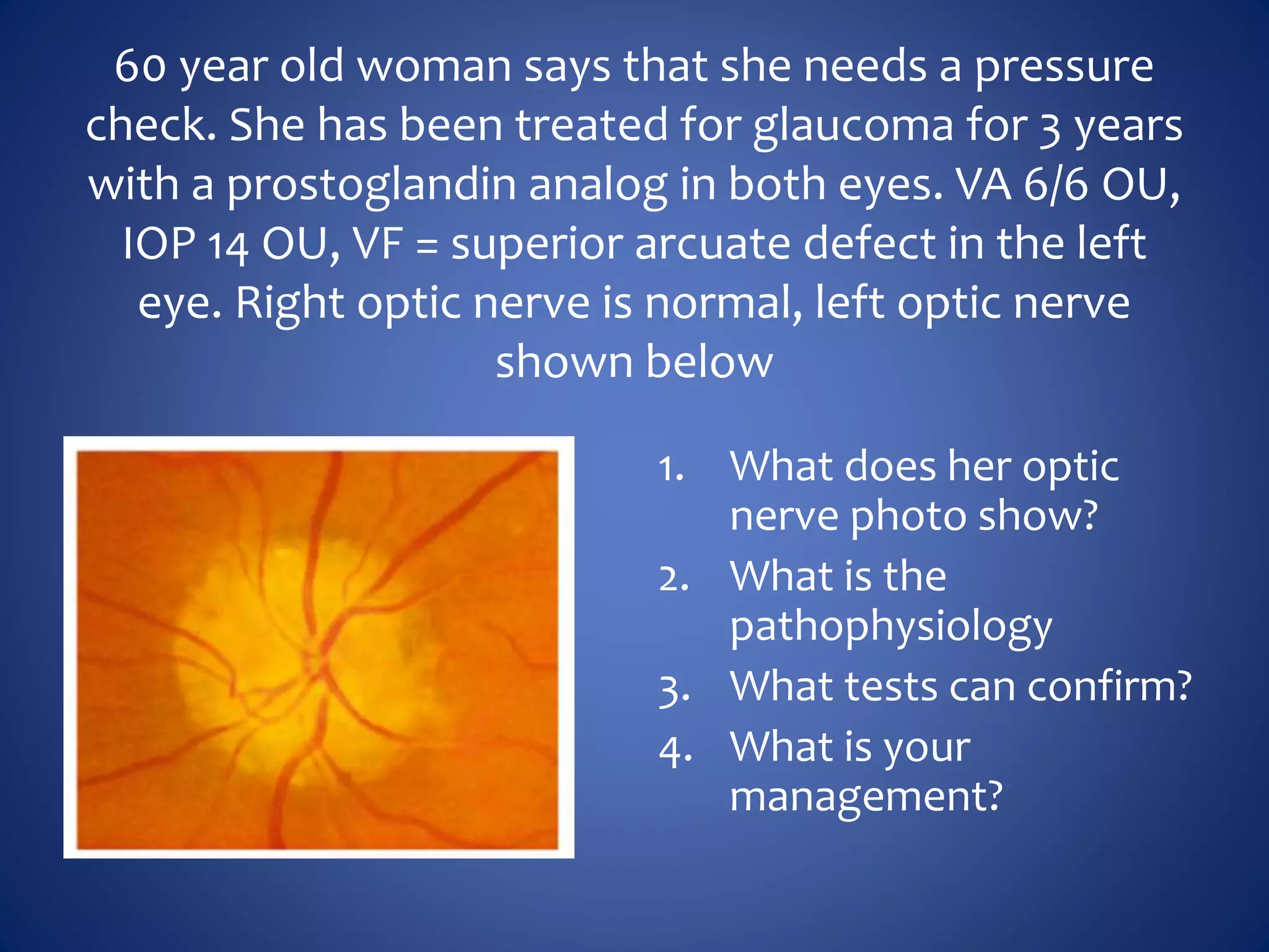 60 year old woman says that she needs a pressure
check. She has been treated for glaucoma for 3 years
with a prostoglandin analog in both eyes. VA 6/6 OU,
IOP 14 OU, VF = superior arcuate defect in the left
eye. Right optic nerve is normal, left optic nerve
shown below
1. What does her optic
nerve photo show?
2. What is the
pathophysiology
3. What tests can confirm?
4. What is your
management?
 