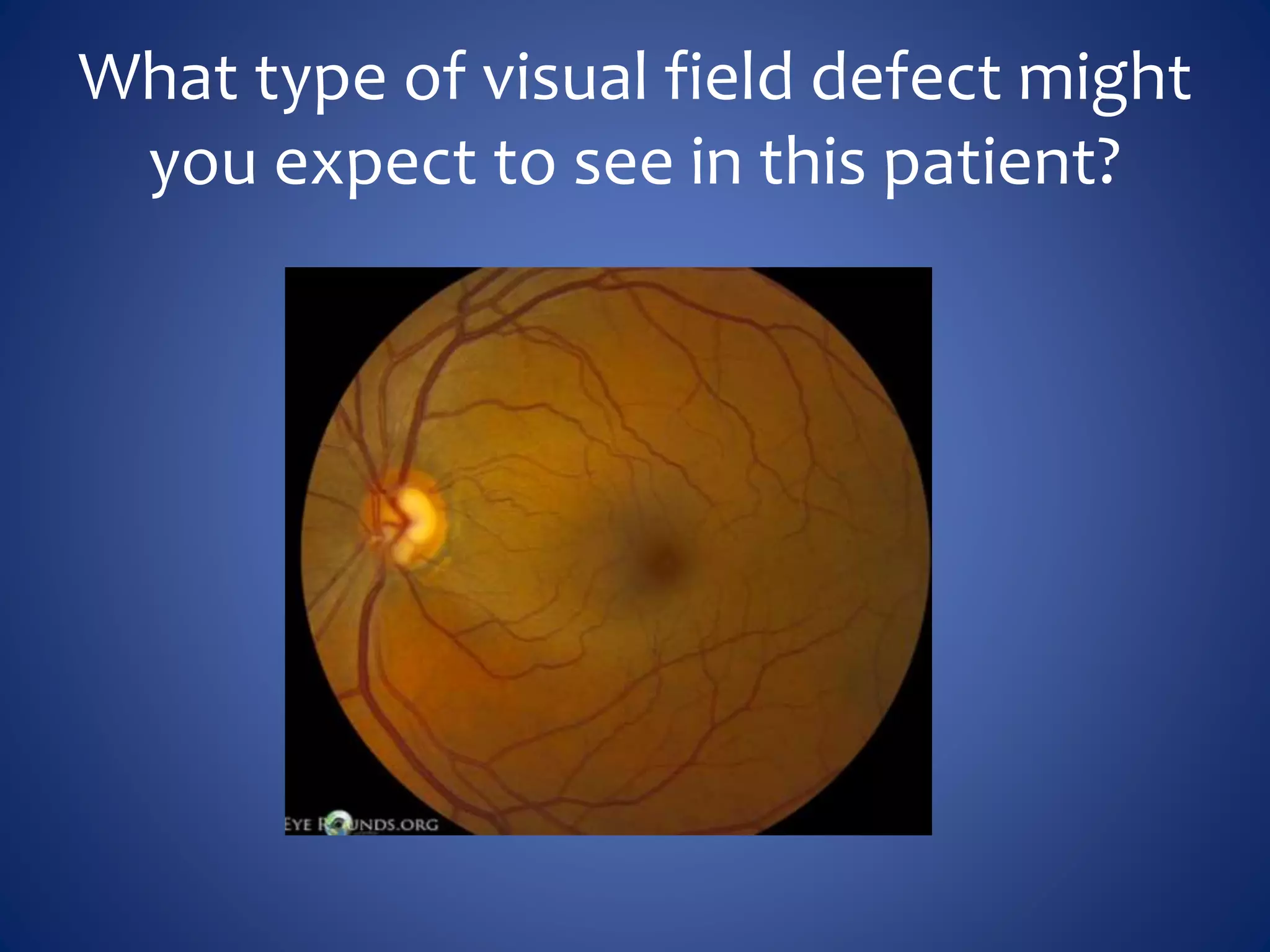 What type of visual field defect might
you expect to see in this patient?
 