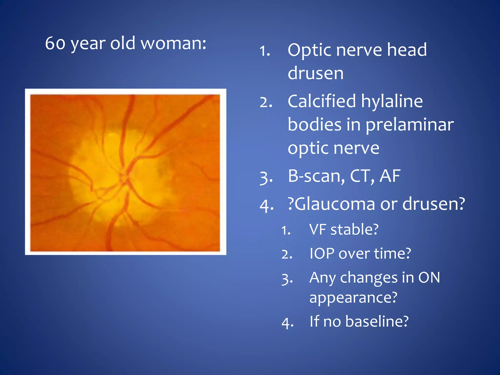 60 year old woman: 1. Optic nerve head
drusen
2. Calcified hylaline
bodies in prelaminar
optic nerve
3. B-scan, CT, AF
4. ?Glaucoma or drusen?
1. VF stable?
2. IOP over time?
3. Any changes in ON
appearance?
4. If no baseline?
 