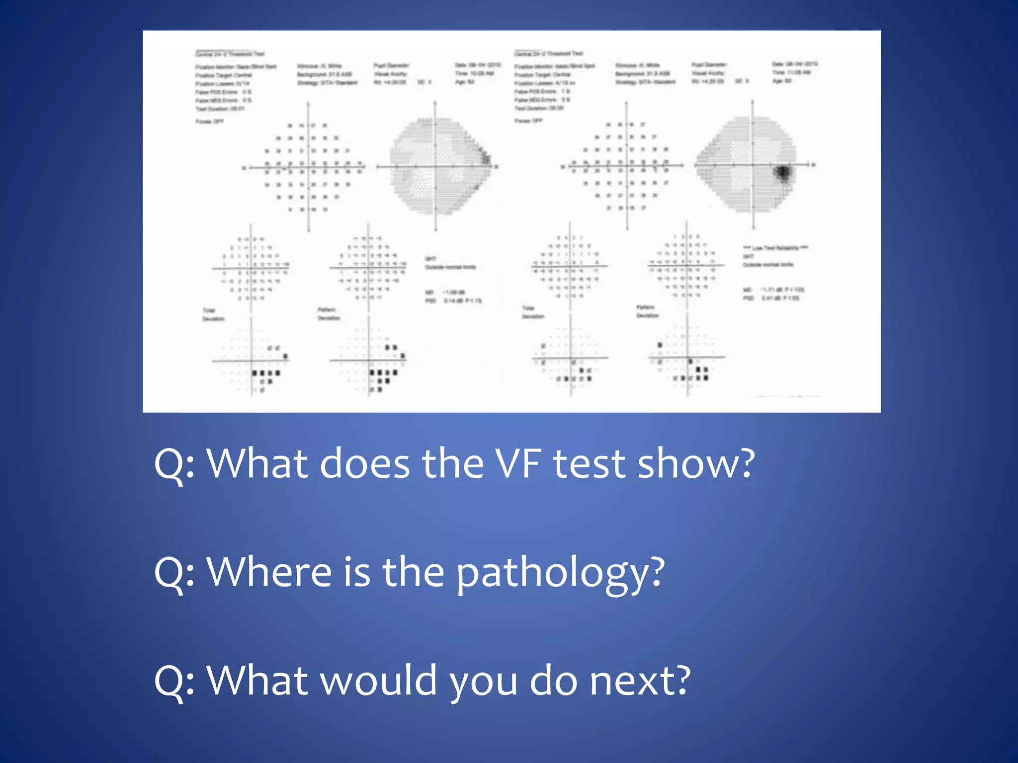 Q: What does the VF test show?
Q: Where is the pathology?
Q: What would you do next?
 