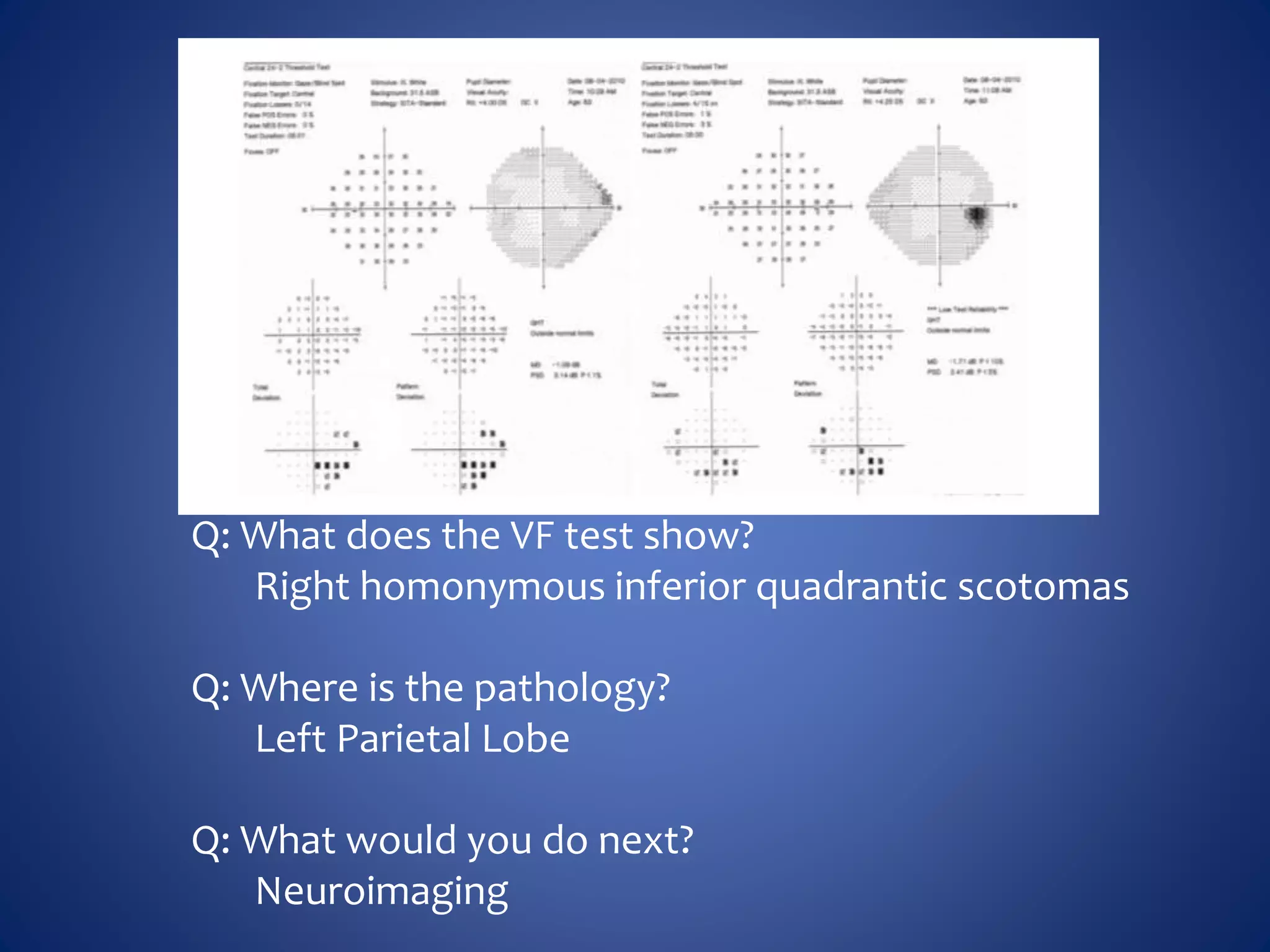Q: What does the VF test show?
Right homonymous inferior quadrantic scotomas
Q: Where is the pathology?
Left Parietal Lobe
Q: What would you do next?
Neuroimaging
 