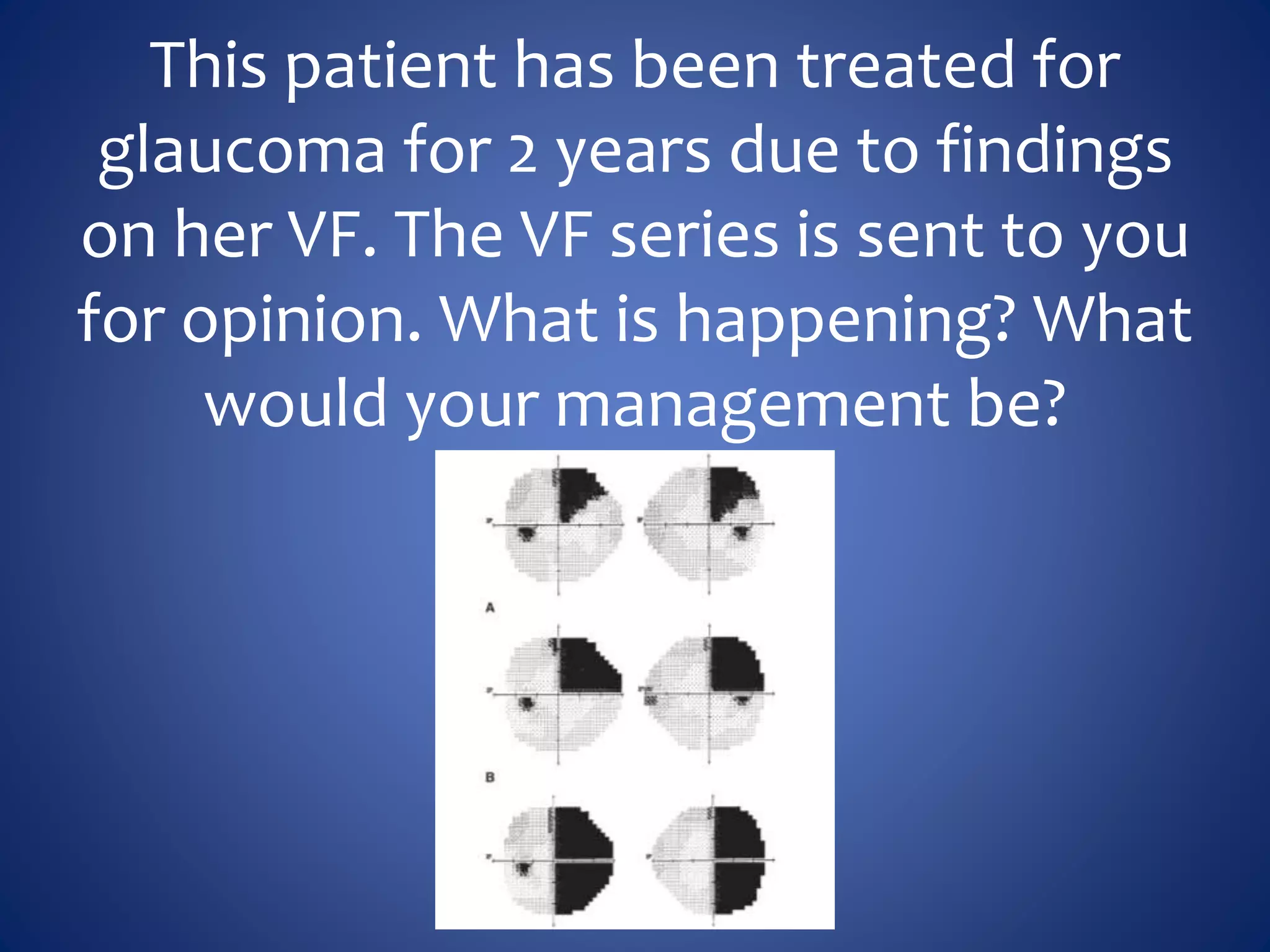This patient has been treated for
glaucoma for 2 years due to findings
on her VF. The VF series is sent to you
for opinion. What is happening? What
would your management be?
 