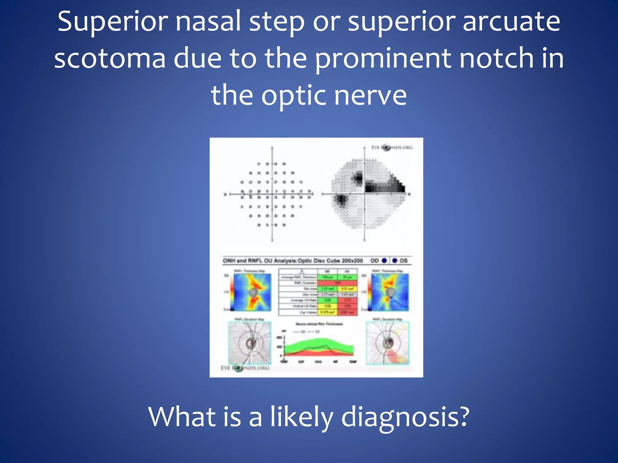 Superior nasal step or superior arcuate
scotoma due to the prominent notch in
the optic nerve
What is a likely diagnosis?
 