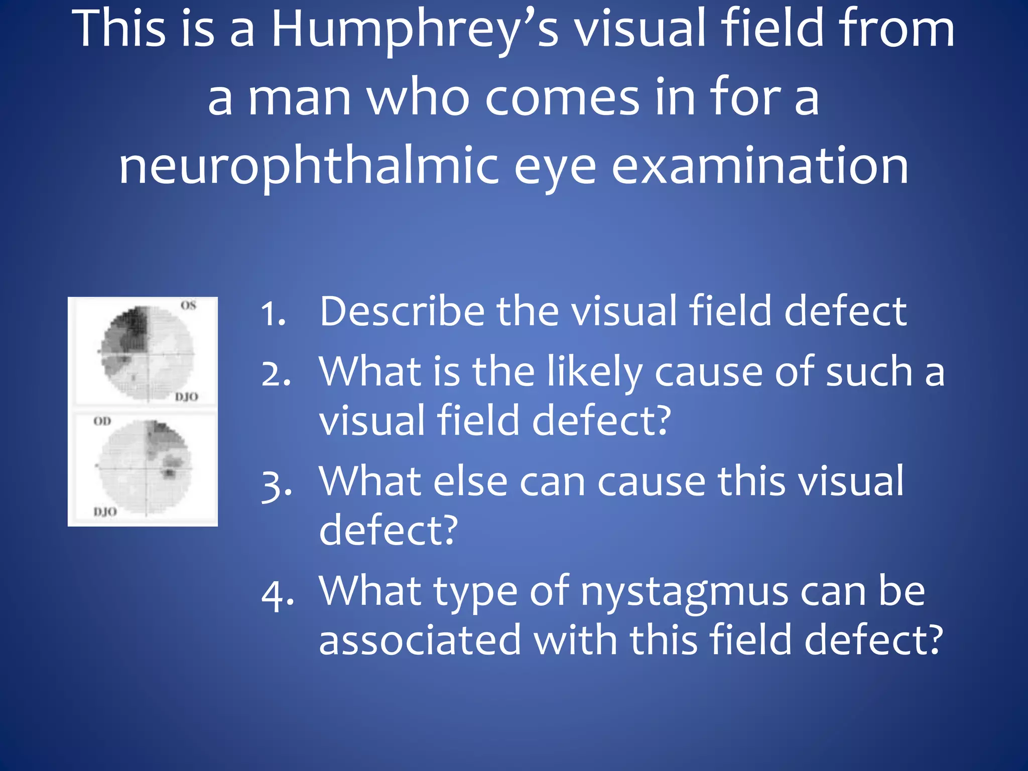 This is a Humphrey’s visual field from
a man who comes in for a
neurophthalmic eye examination
1. Describe the visual field defect
2. What is the likely cause of such a
visual field defect?
3. What else can cause this visual
defect?
4. What type of nystagmus can be
associated with this field defect?
 