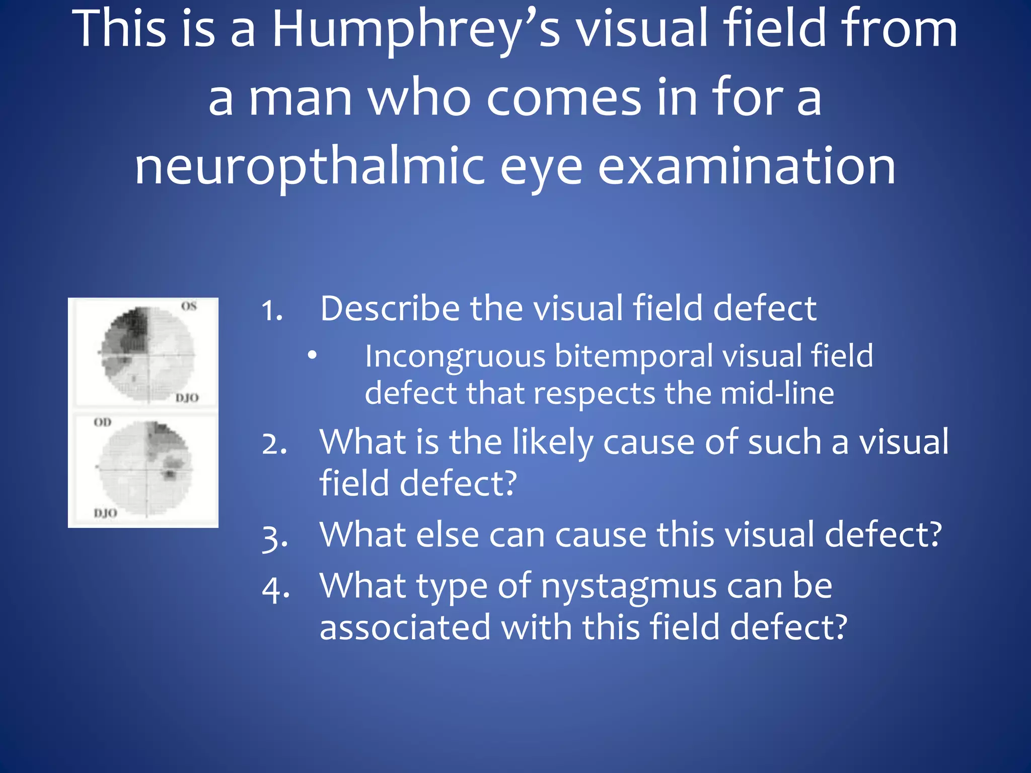 This is a Humphrey’s visual field from
a man who comes in for a
neuropthalmic eye examination
1. Describe the visual field defect
• Incongruous bitemporal visual field
defect that respects the mid-line
2. What is the likely cause of such a visual
field defect?
3. What else can cause this visual defect?
4. What type of nystagmus can be
associated with this field defect?
 