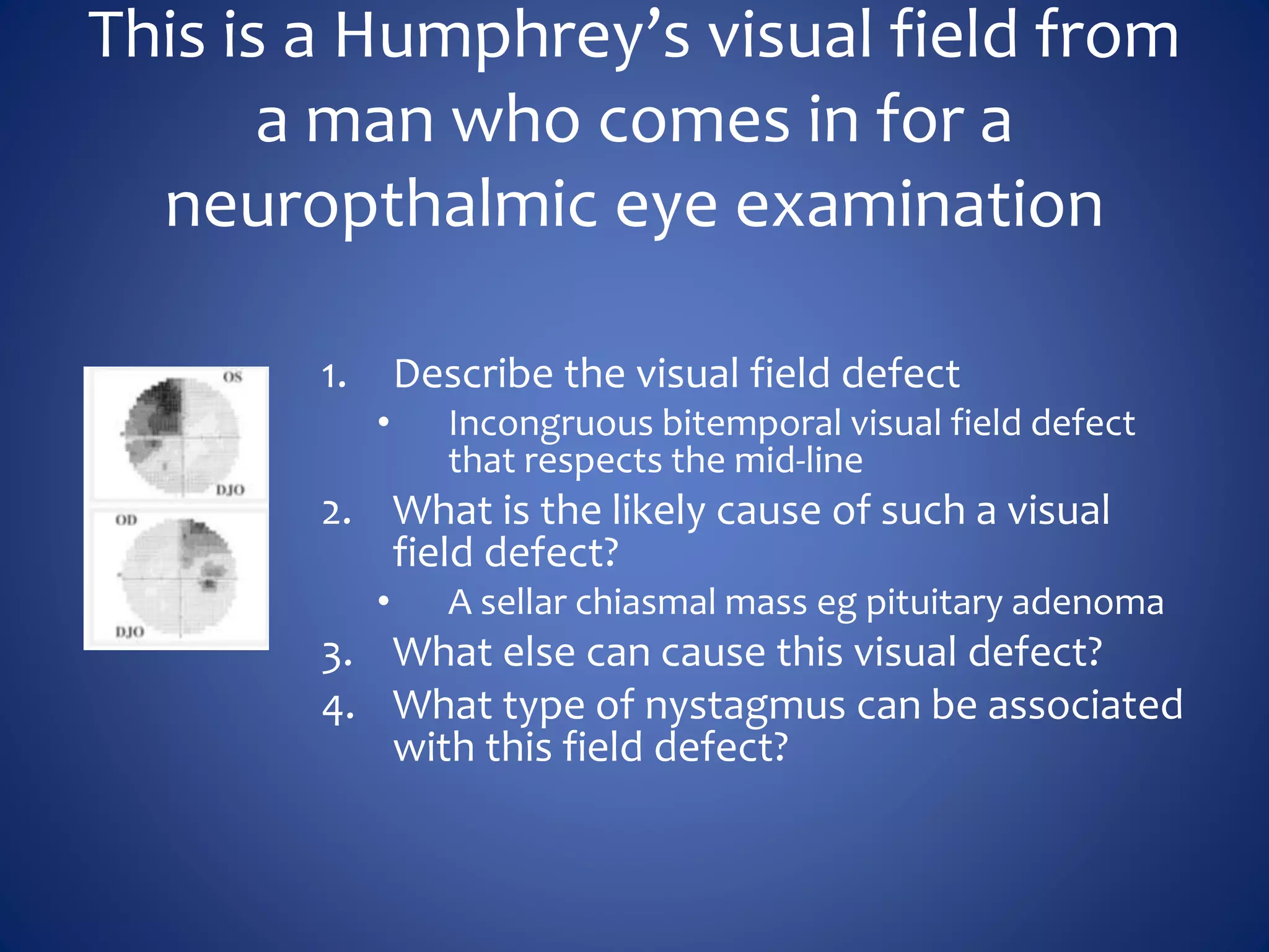 This is a Humphrey’s visual field from
a man who comes in for a
neuropthalmic eye examination
1. Describe the visual field defect
• Incongruous bitemporal visual field defect
that respects the mid-line
2. What is the likely cause of such a visual
field defect?
• A sellar chiasmal mass eg pituitary adenoma
3. What else can cause this visual defect?
4. What type of nystagmus can be associated
with this field defect?
 