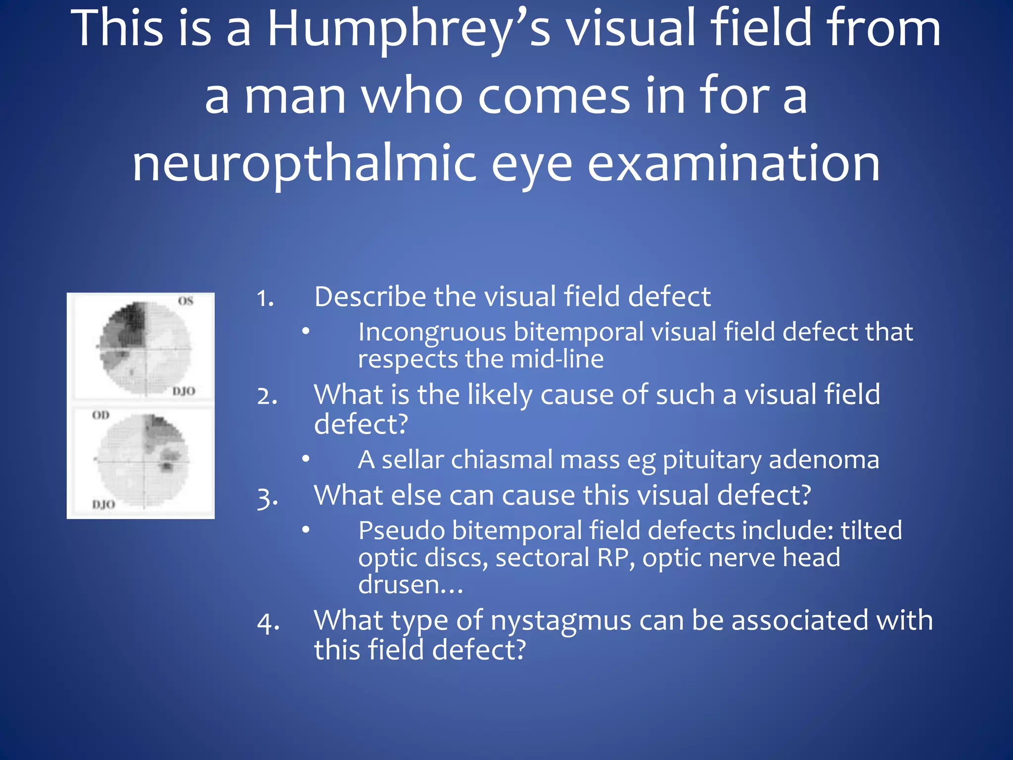 This is a Humphrey’s visual field from
a man who comes in for a
neuropthalmic eye examination
1. Describe the visual field defect
• Incongruous bitemporal visual field defect that
respects the mid-line
2. What is the likely cause of such a visual field
defect?
• A sellar chiasmal mass eg pituitary adenoma
3. What else can cause this visual defect?
• Pseudo bitemporal field defects include: tilted
optic discs, sectoral RP, optic nerve head
drusen…
4. What type of nystagmus can be associated with
this field defect?
 