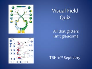 Visual Field
Quiz
All that glitters
isn’t glaucoma
TBH 11th Sept 2015
 