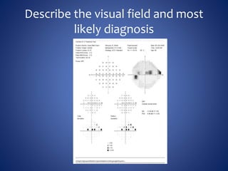 Visual Field Quiz | PPTX