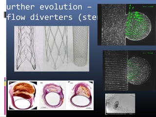 Further evolution –
flow diverters (stents)
 