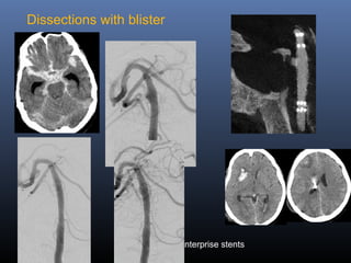 Dissections with blister
EVD
2-overlapping Enterprise stents
 