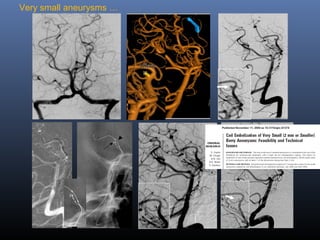 Very small aneurysms …
 