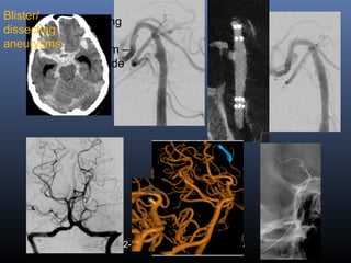 Dissecting
blister
aneurysm –
poor grade
EVD
2-overlapping Enterprise stents
Blister/
dissecting
aneurysms
 