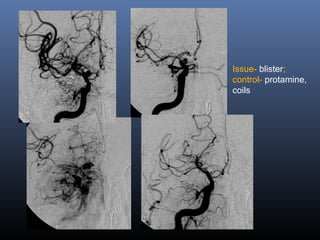 Issue- blister;
control- protamine,
coils
 