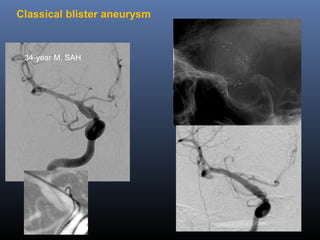 Classical blister aneurysm
34-year M, SAH
 