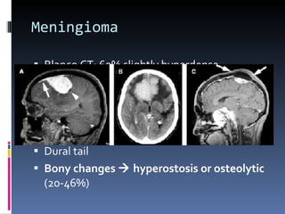 Meningioma Blanco CT: 60% slightly hyperdense 20% calcification MR T1: iso/ slightly hypointens to gray matter MRT2: iso/hyperintens Strongly enhancing Dural tail Bony changes    hyperostosis or osteolytic  (20-46%) 
