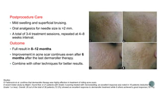  Release subcutaneous fibrotic strands in a rolling scar that improve with stretching the skin
The mechanisms of scar imp...