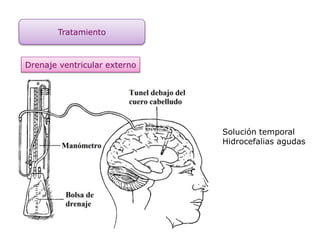 Tratamiento
Drenaje ventricular externo
Solución temporal
Hidrocefalias agudas
 