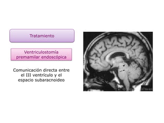 Tratamiento
Ventriculostomía
premamilar endoscópica
Comunicación directa entre
el III ventrículo y el
espacio subaracnoideo
 