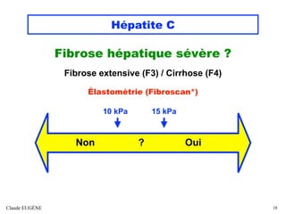 Hépatite C
Fibrose hépatique sévère ?
Fibrose extensive (F3) / Cirrhose (F4)
Élastométrie (Fibroscan*)
10 kPa 15 kPa
Claud...