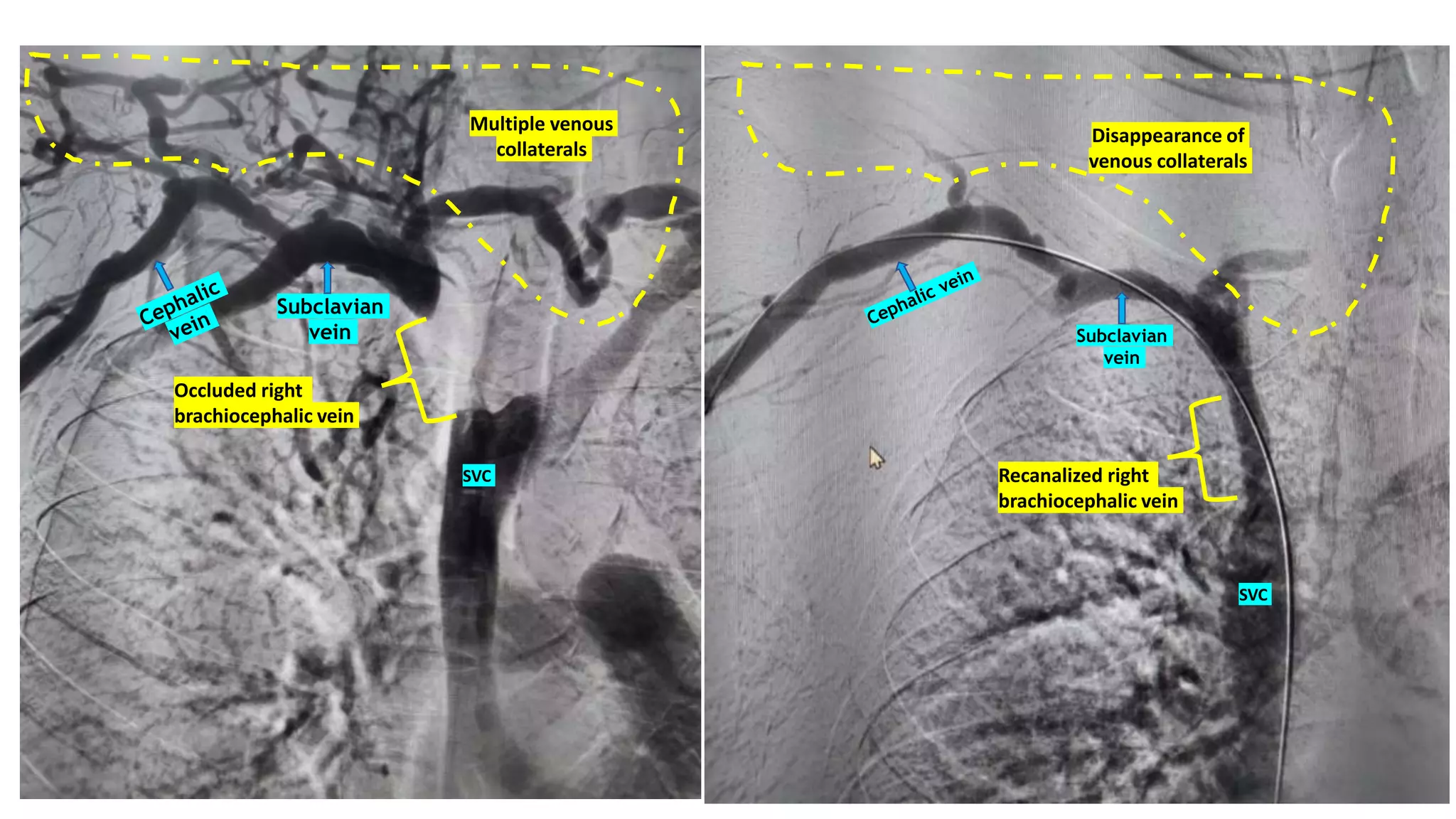 Invasive Radiology Interventional Radiology | PPTX