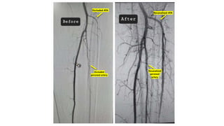Recanalized ATA
Recanalized
peroneal
artery
Occluded
peroneal artery
Occluded ATA
 