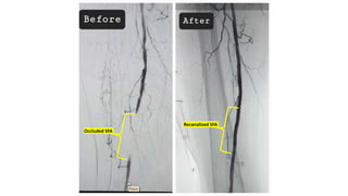 Recanalized SFA
Occluded SFA
 