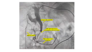 PTBD catheter in the
duodenum
Common Bile Duct(CBD)
CBD obstruction due to
periampullary adenocarcinoma
Pigtail for ascites
 