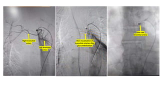 Right bronchial
artery
Left bronchial
artery
Non visualization of
bronchial arteries after
glue embolization
Glue cast
bronchial artery
 