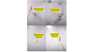 Right Uterine artery
abnormal blush
Left Uterine artery
abnormal blush
Right Uterine artery
No blush after
embolization
Left Uterine artery
No blush after
embolization
 