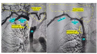Occluded right
brachiocephalic vein
Recanalized right
brachiocephalic vein
Multiple venous
collaterals
Disappearance of
venous collaterals
SVC
Subclavian
vein Subclavian
vein
SVC
 