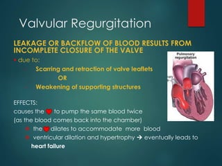 Valvular Regurgitation
LEAKAGE OR BACKFLOW OF BLOOD RESULTS FROM
INCOMPLETE CLOSURE OF THE VALVE
 due to:
- Scarring and ...
