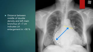  Distance between
middle of double
density and left main
bronchus of >7 cm
indicates LA
enlargement in >90 %
 
