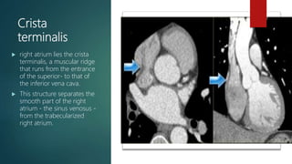 Crista
terminalis
 right atrium lies the crista
terminalis, a muscular ridge
that runs from the entrance
of the superior- to that of
the inferior vena cava.
 This structure separates the
smooth part of the right
atrium - the sinus venosus -
from the trabecularized
right atrium.
 