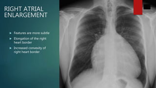 RIGHT ATRIAL
ENLARGEMENT
 Features are more subtle
 Elongation of the right
heart border
 Increased convexity of
right heart border
 