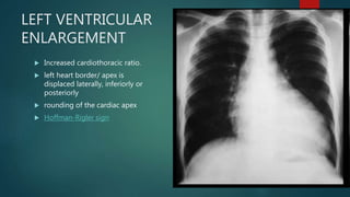 LEFT VENTRICULAR
ENLARGEMENT
 Increased cardiothoracic ratio.
 left heart border/ apex is
displaced laterally, inferiorly or
posteriorly
 rounding of the cardiac apex
 Hoffman-Rigler sign
 