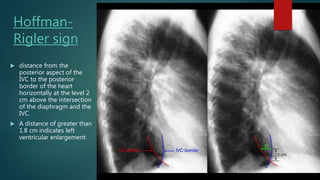 Hoffman-
Rigler sign
 distance from the
posterior aspect of the
IVC to the posterior
border of the heart
horizontally at the level 2
cm above the intersection
of the diaphragm and the
IVC.
 A distance of greater than
1.8 cm indicates left
ventricular enlargement.
 