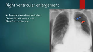 Right ventricular enlargement
 Frontal view demonstrates:
 rounded left heart border
 uplifted cardiac apex
 