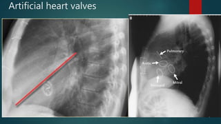 Artificial heart valves
 